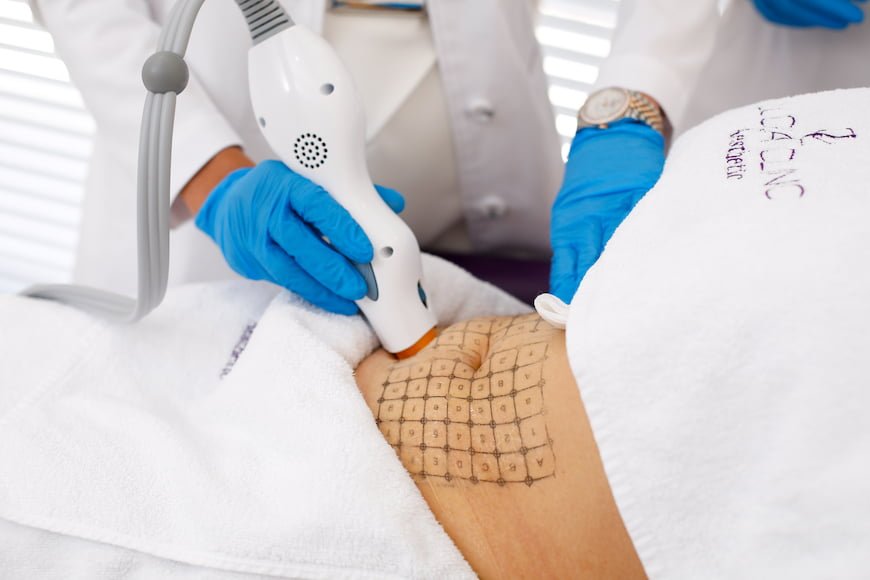 Thermage for the body treatment, safe, fast and effective - firm loose skin on all body areas and smooth uneven dimpled skin to temporarily reduce cellulite.