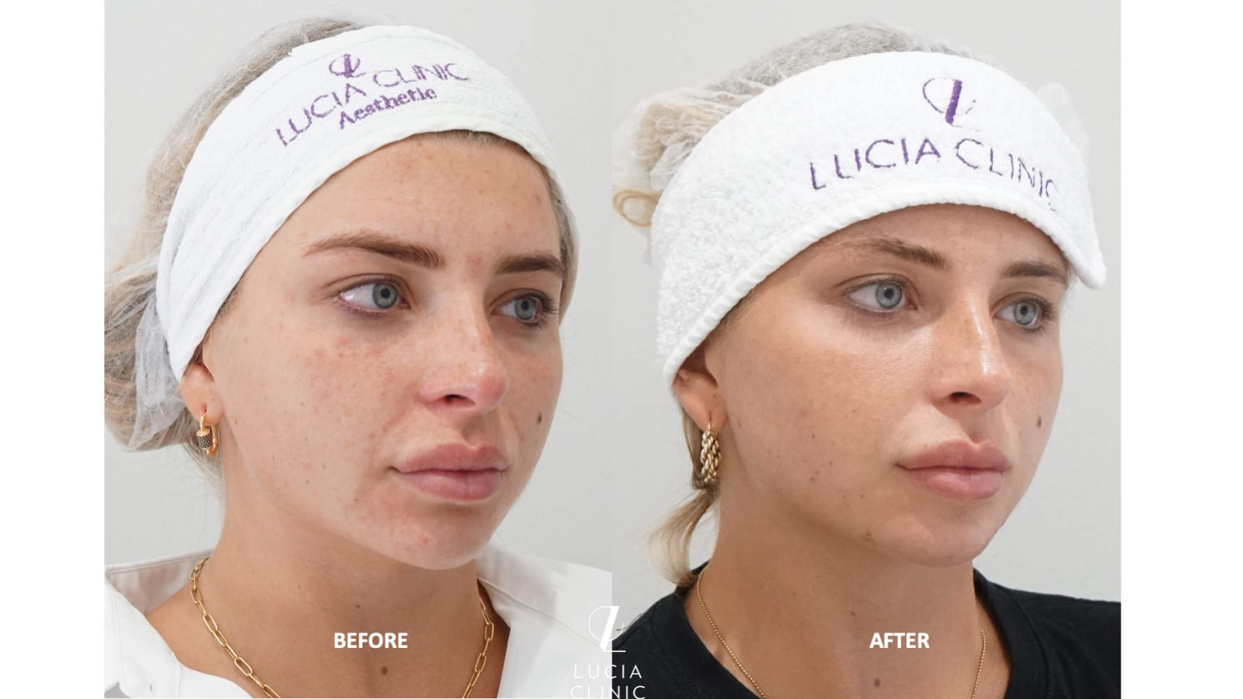 AFT PHOTOREJUVENATION - A JOURNEY TO A BRIGHTER COMPLEXION