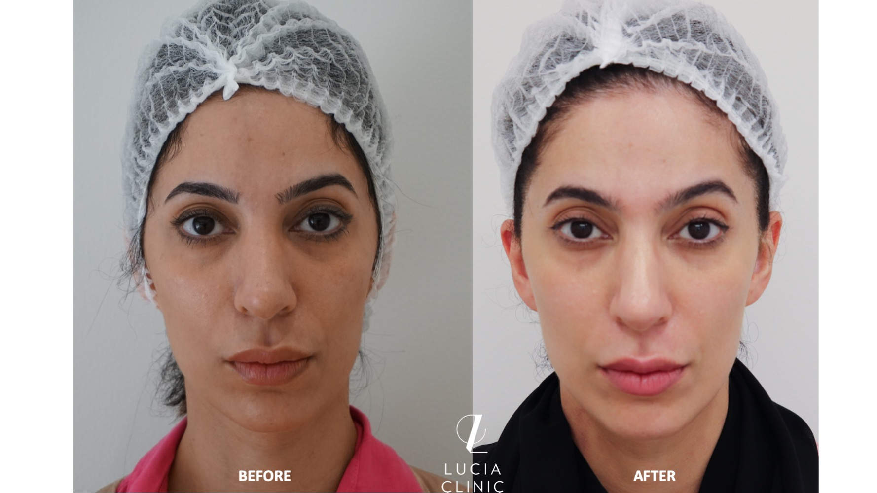 HOW DID ULTHERAPY® TREATMENT HELP SABRYA IMPROVE HER SKIN?