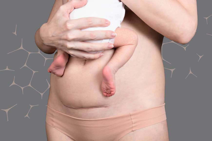 Mummy makeover, plastic surgery to restore pre-baby body - return your confidence with a surgery that includes a tummy tuck, breast surgery and liposuction.