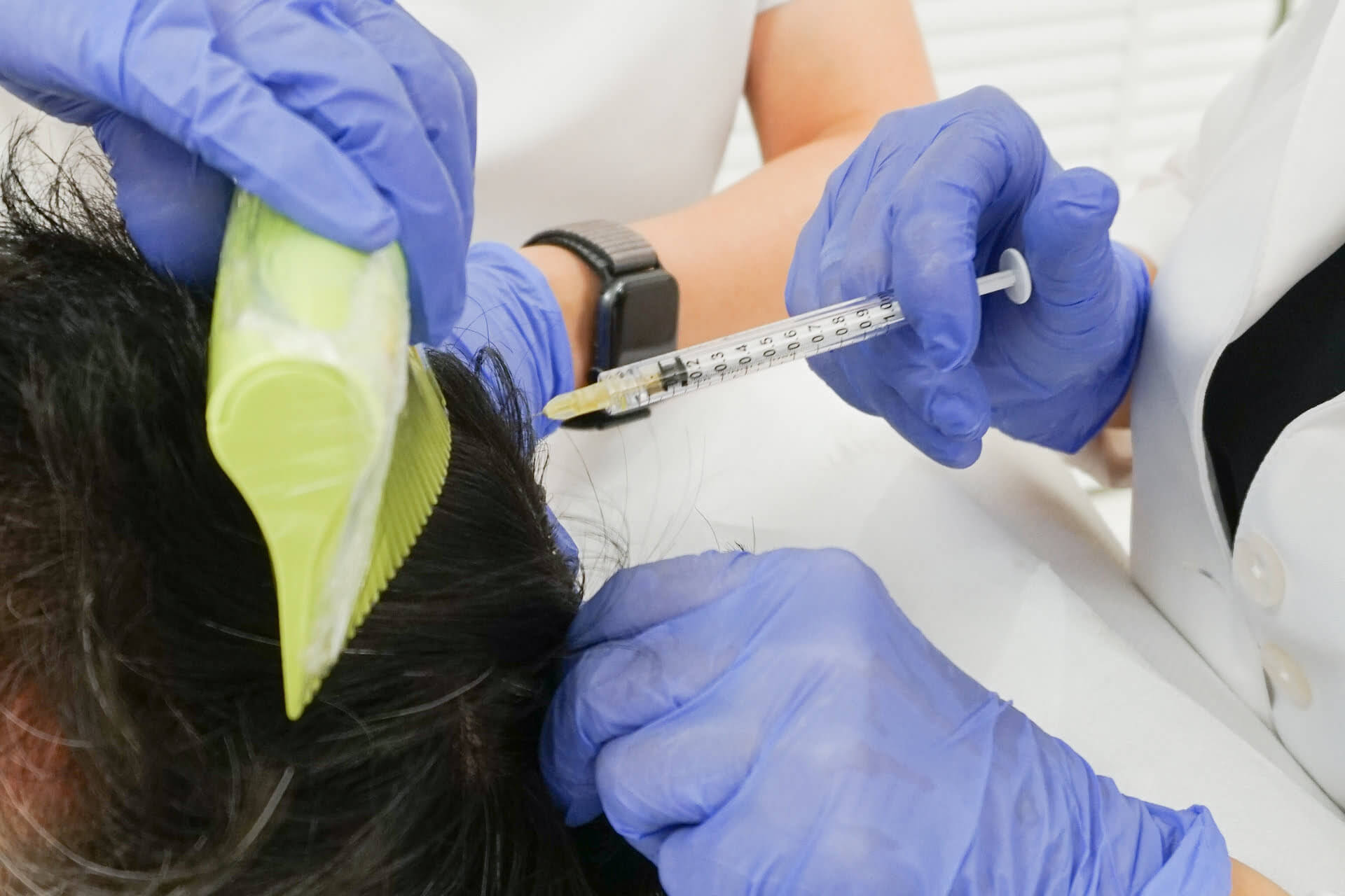 Acell+PRP for advanced and safe hair restoration treatment - rejuvenate your scalp and stimulate healthy hair growth with this powerful injectable treatment.