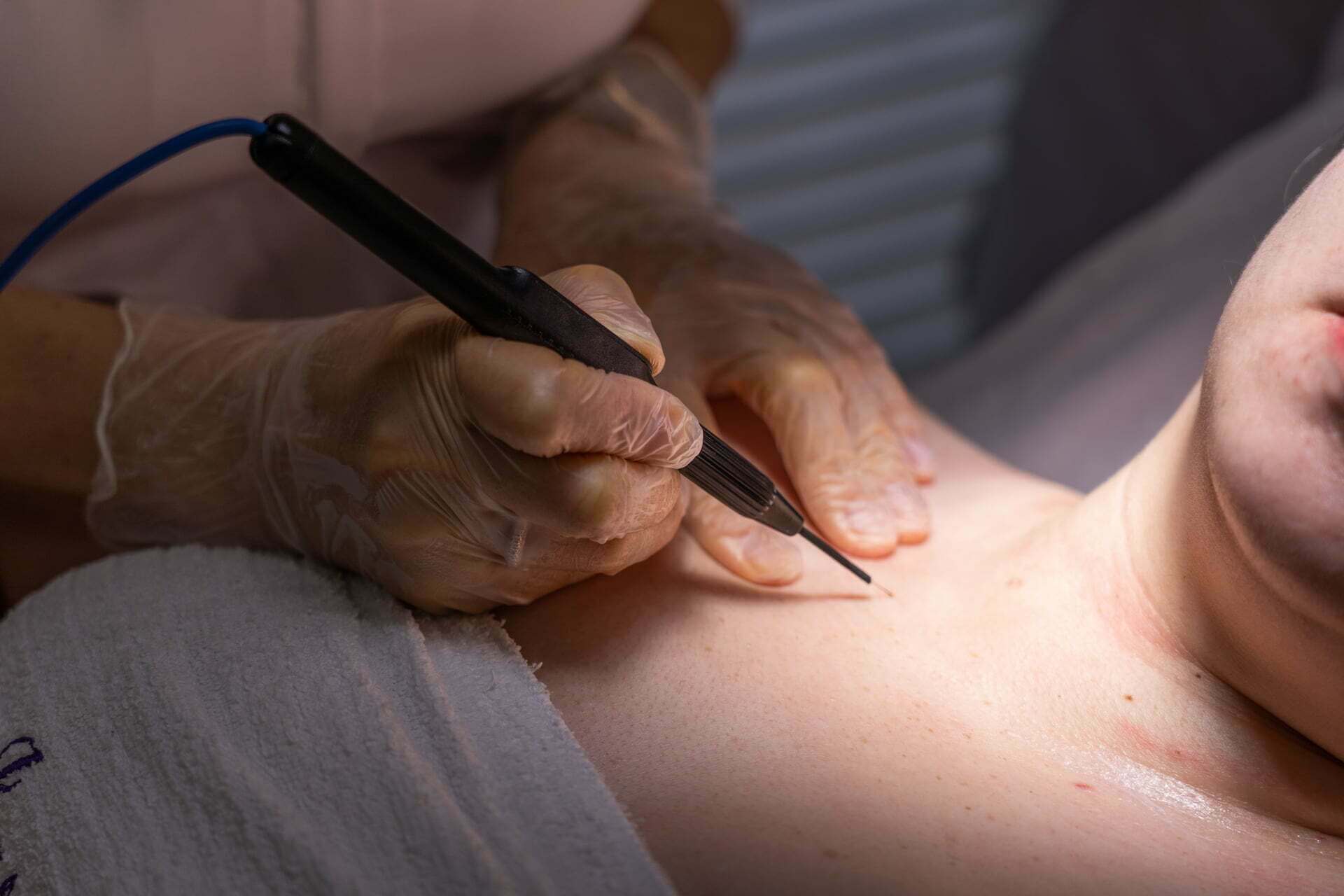 Skin tag removal treatments for the healthy-looking skin - get a safe and effective treatment like Cryotherapy or cauterization to remove unwanted skin tags.