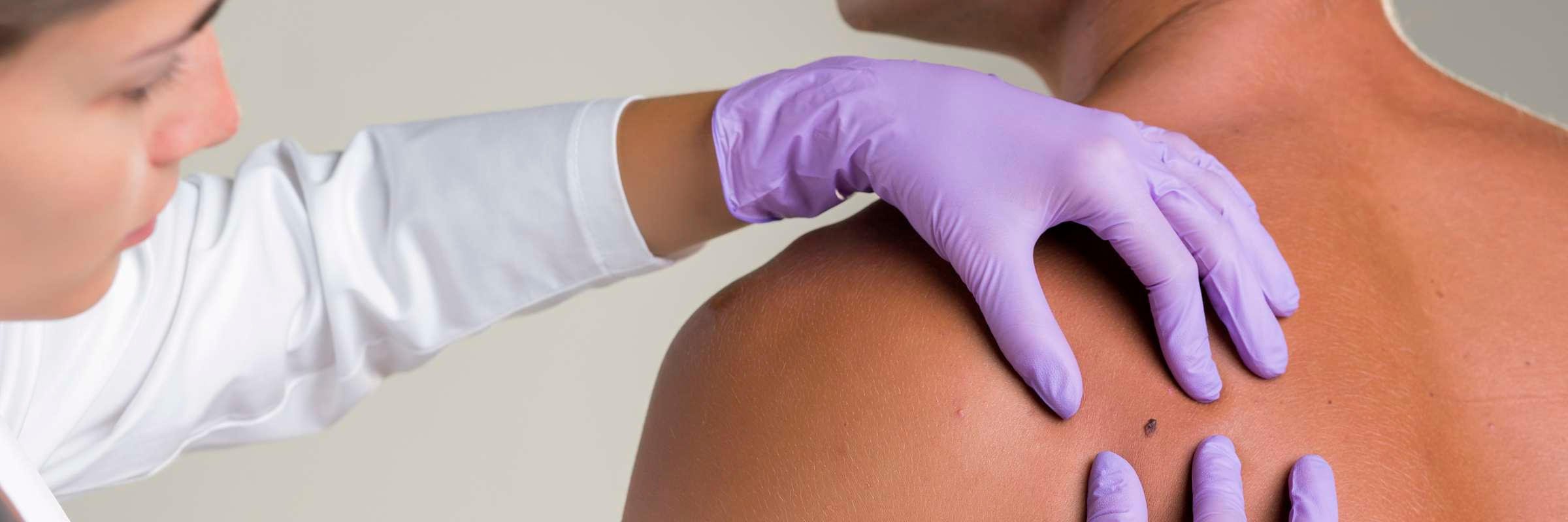 Regular mole and other skin lesions check at Lucia Clinic