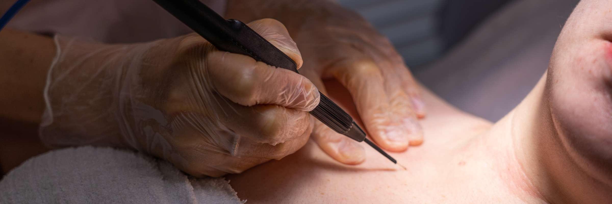 Effective skin tags removal treatments at Lucia Clinic