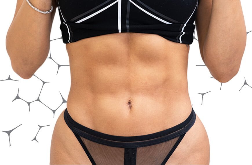 Perfectly chiseled 6-pack abs with right plastic surgery - try advanced liposuction techniques to define and shape abs after removing the fat that hides them.