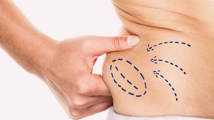 Lucia Liposuction surgery for the ultimate body contouring – Eliminate unwanted fat bulges from different body areas and bring your silhouette to perfection.