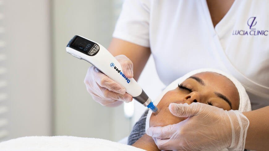 Microneedling for best skin rejuvenation at Lucia Clinic
